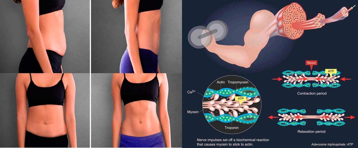 cómo conseguir un abdomen plano mujer Tecnología HIFEM