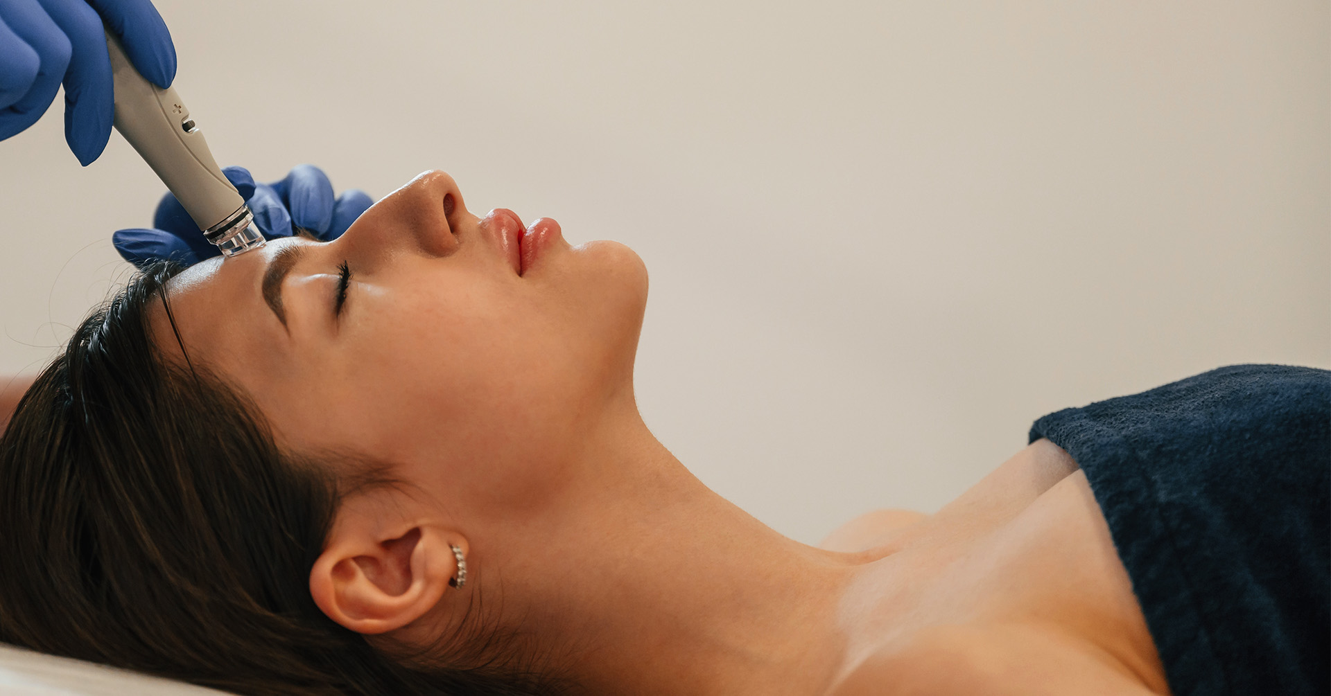 microneedling mesoterapia facial
