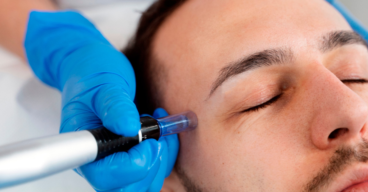 Microneedling hombre en Madrid