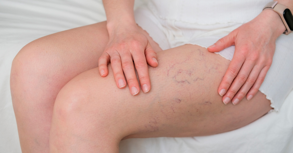 Escleroterapia con láser
